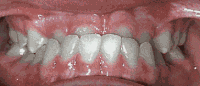 Orthodontic Before and After Case 4